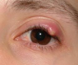 симптомы розацеа глаз