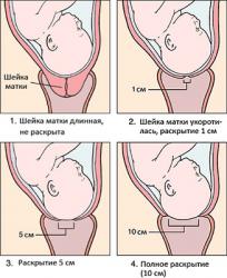осложнения хламидиоза при беременности