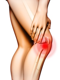 Что такое гонартроз коленного сустава