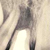 Гранулема зуба и ее лечение