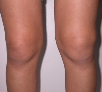 Что такое реактивный синовит коленного сустава и методы его лечения. Реактивный синовит коленного сустава что это такое