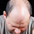 Алопеция (облысение, выпадение волос). Причины, виды, лечение и профилактика патологии