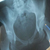 Рентген костей. Нормальная лучевая анатомия. Диагностика заболеваний костей с помощью рентгена