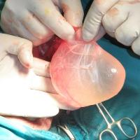 Водянка яичка у мужчин после операции паховой грыжи фото