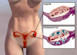 Лечение угревой сыпи при поликистозе яичников thumbnail