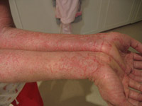 Энтеросгель при аллергическом дерматите отзывы