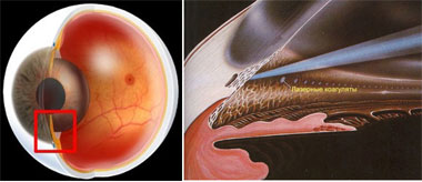 Современные способы лечения глаукомы