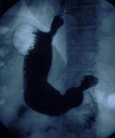 Рентген желудка и двенадцатиперстной кишки