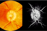 Гипертоническая ретинопатия – что это такое?