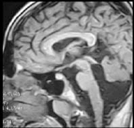Гипоплазия мозжечка