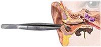 Первая помощь при попадании инородного тела в ухо