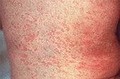 Патогенез вируса краснухи в организме