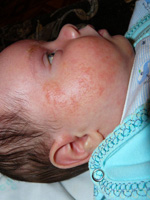 Пищевая аллергия у грудного ребенка – признаки и методы терапии