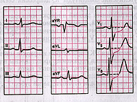Кардиограмма – график работы сердца