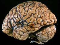 Чего ожидать от некроза опухолей головного мозга?