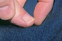 Болезни ногтей и их лечение