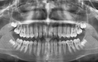 Рентген в стоматологии