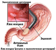 Эндоскопия желудка