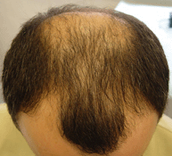 Выпадение волос у мужчин и методы терапии данного явления