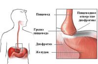 Диафрагмальные грыжи и другие врожденные пороки желудочно-кишечного тракта