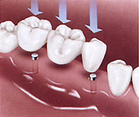 Имплантация зубов может вызвать ряд осложнений