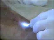 Cвет в руках хирургов - лазер
