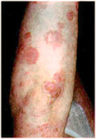 Пиодермия кожи. Причины заболевания