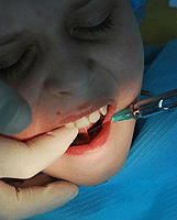 Анестезия при зубной боли