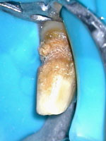 Некроз тканей зуба