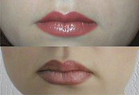Гипертрофия губ