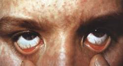 Профилактика гиперемии глаз