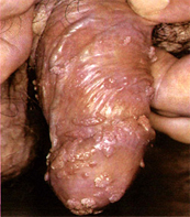 Папилломовирусная инфекция на половом члене