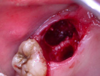Кровотечение после операции по удалению зуба