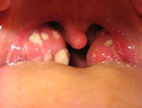 Флегмона полости рта