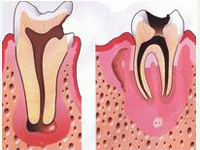 Лечение гранулемы зуба народными средствами