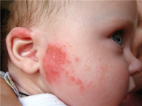 Наружные противовоспалительные средства при атопическом дерматите у детей