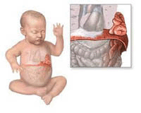 Врожденные диафрагмальные грыжи у детей – общие сведения