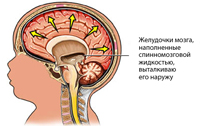 Гидроцефалия головного мозга. Симптомы