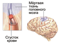 Инсульт головного мозга