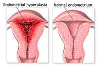 Что представляет собой эндометриоз?