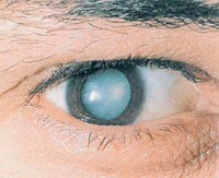 Близорукость и катаракта
