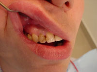 Зубной камень – причина развития пародонтита