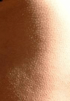 Гусиная кожа – общие сведения