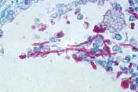 Лейкоциты в спермограмме