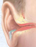 Заложенность уха при отите и методы терапии данного заболевания
