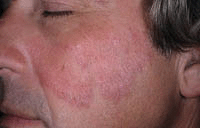 Клиническая картина грибковых заболеваний кожи