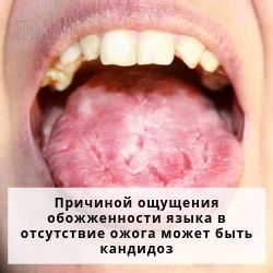 Народные средства лечения ожога языка