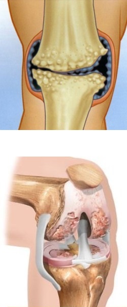 Физиопроцедуры при артрите коленного сустава