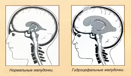 Заместительная гидроцефалия головного мозга - симптомы и лечение