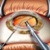 Катаракта – консервативное лечение, виды операций по замене хрусталика глаза, народные средства, профилактика. Цена операции по удалению катаракты